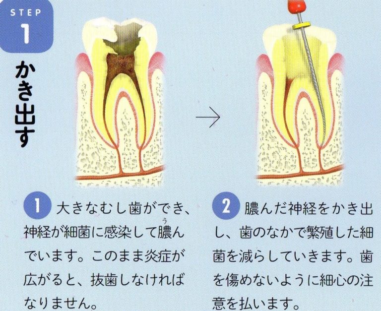 膝の神経が圧迫される原因は何ですか?