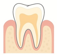 根面う蝕（こんめんうしょく）とは？