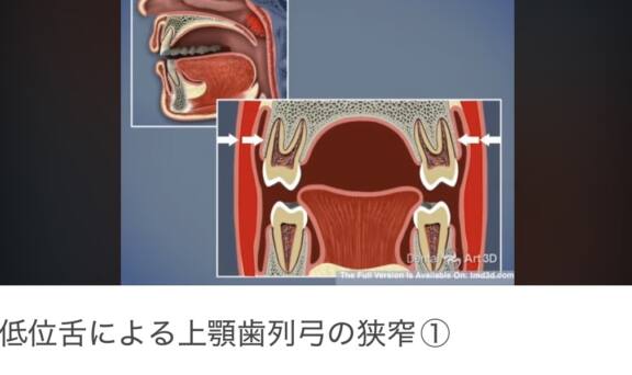 舌のポスチャー（正しい舌の位置）について②