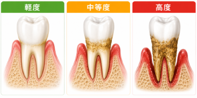 歯肉炎と歯周病の違いをご存じですか？