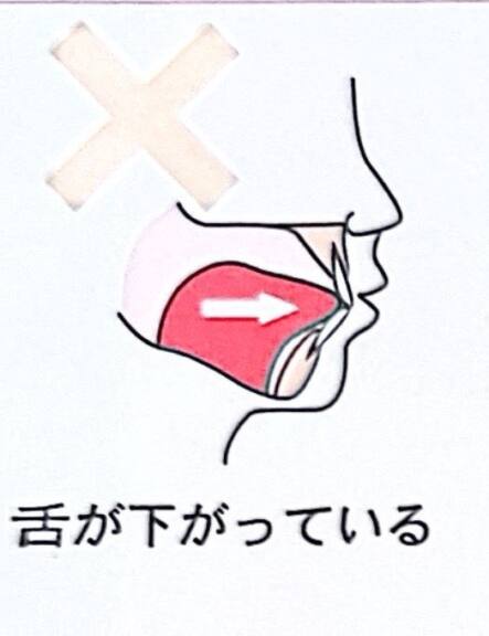 舌のポスチャー（正しい舌の位置）について①