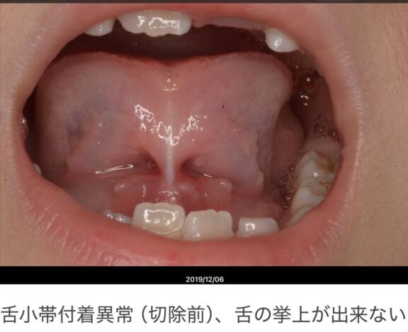 舌のポスチャー（正しい舌の位置）について④